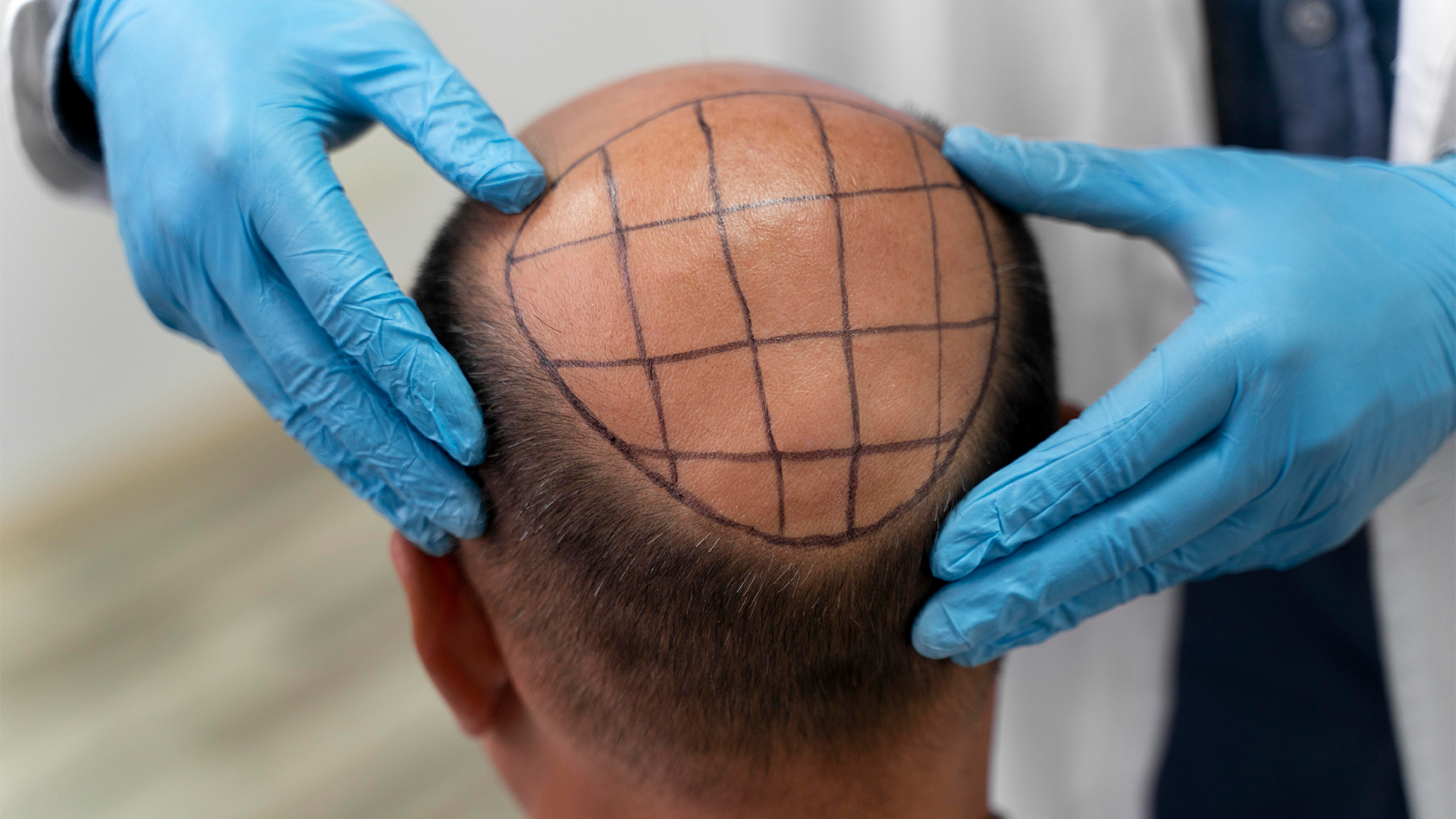 FUE Hair Transplant