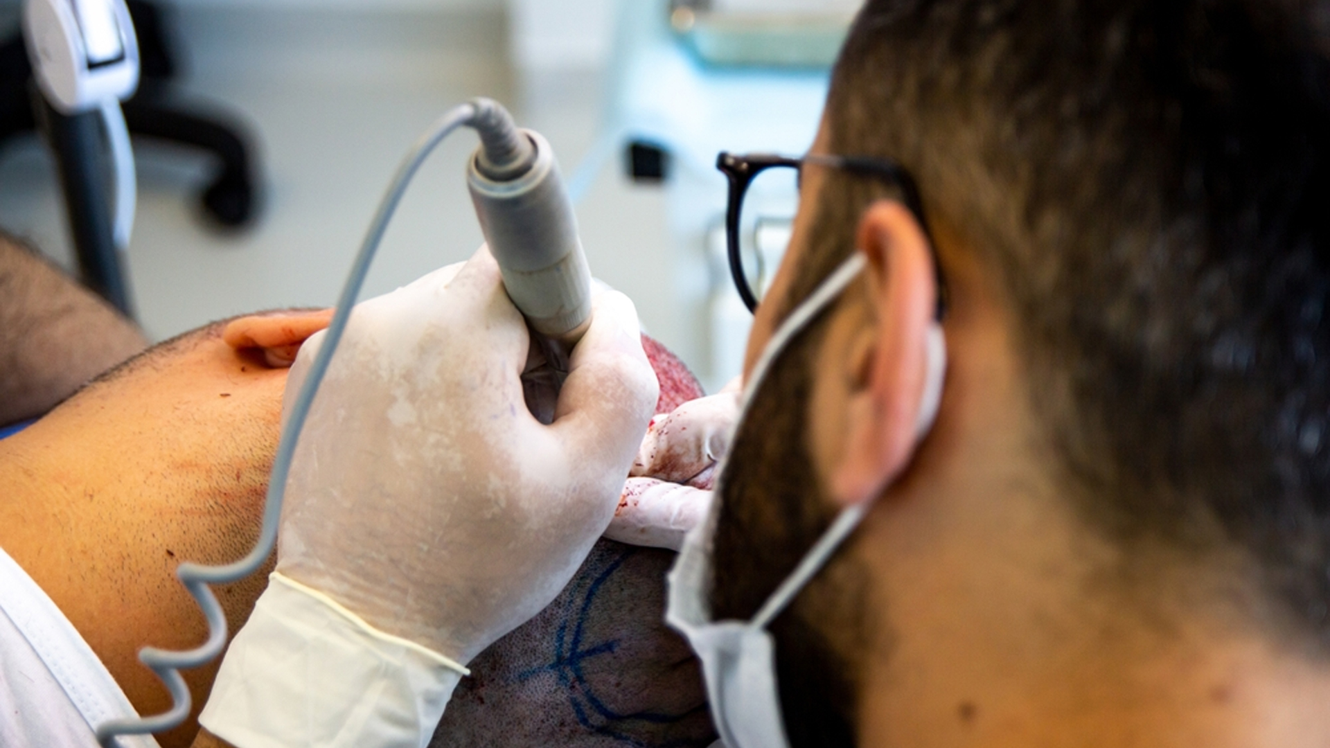 FUT Hair Transplant